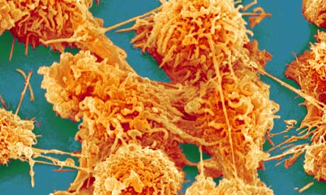 Cellules de cancer du colon grossissement 2000 (c) Corbis images