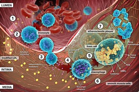 Inflammation vasculaire